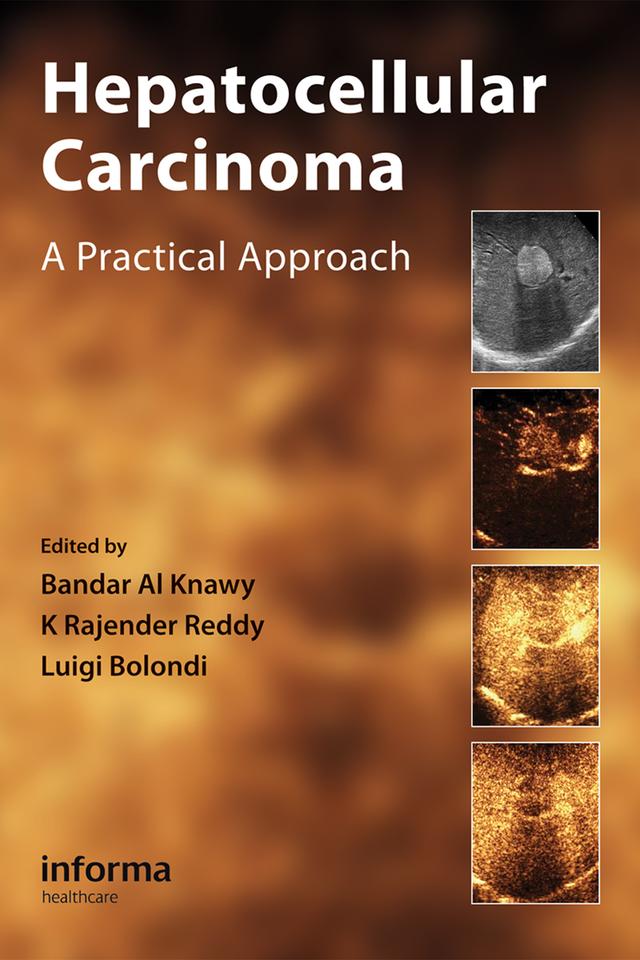Hepatocellular Carcinoma by Bandar Al Knawy, K. Rajender Reddy, Luigi Bolondi