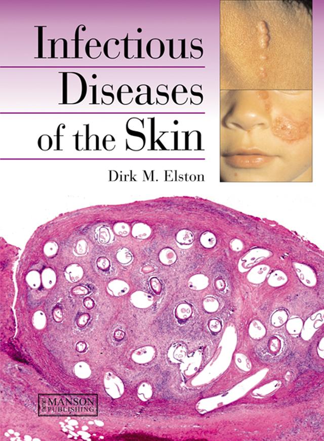 Infectious Diseases of the Skin by Dirk Elston