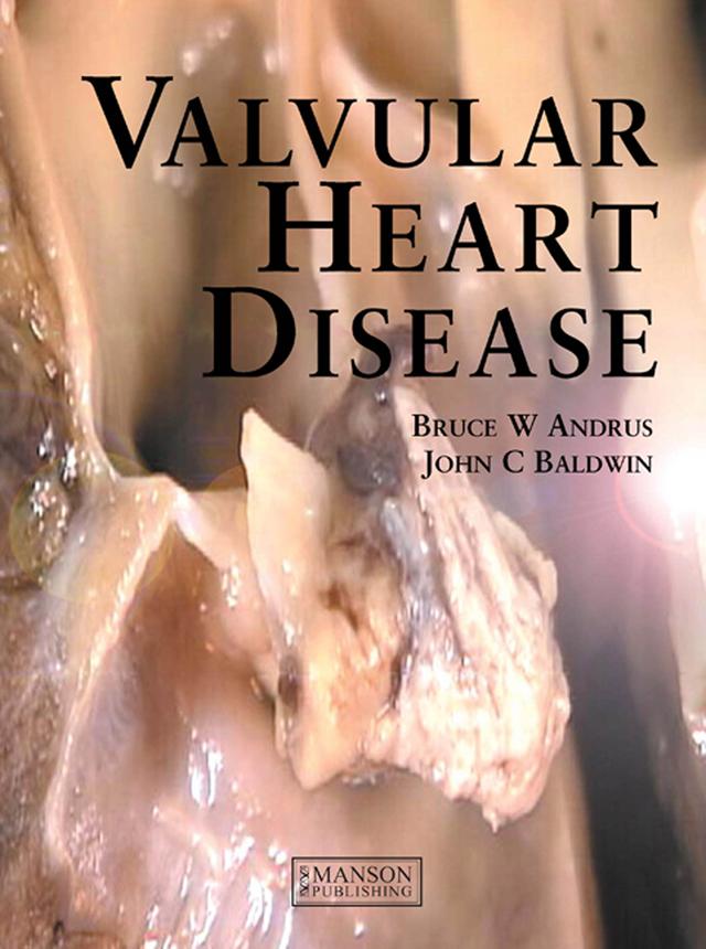 Valvular Heart Disease by Bruce Andrus, John Baldwin