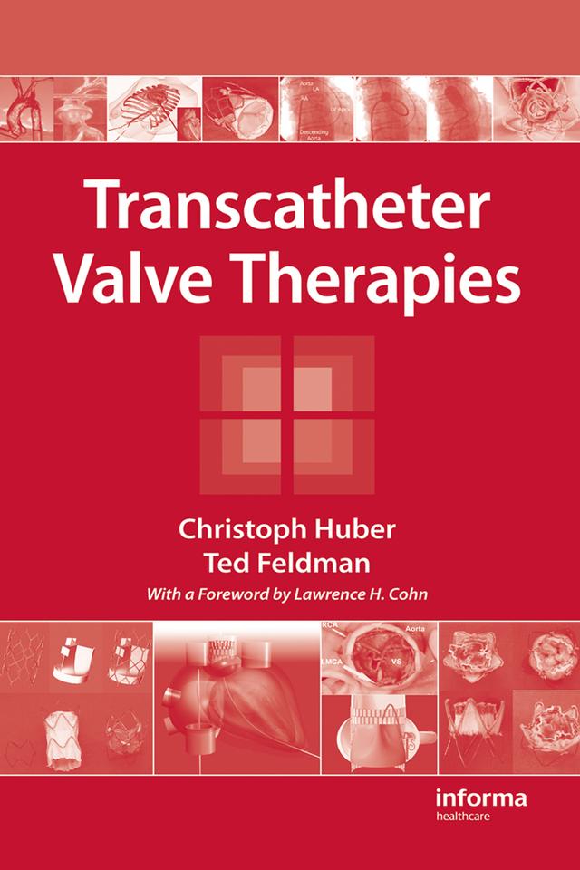 Transcatheter Valve Therapies by Christoph Huber, Ted Feldman