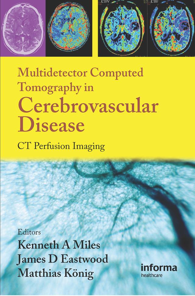 Multidetector Computed Tomography in Cerebrovascular Disease by James D. Eastwood, Kenneth Miles, Matthias Konig