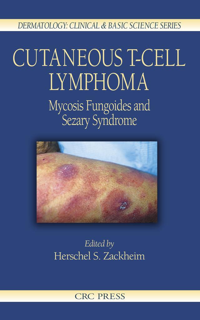 Cutaneous T-Cell Lymphoma by Herschel S. Zackheim