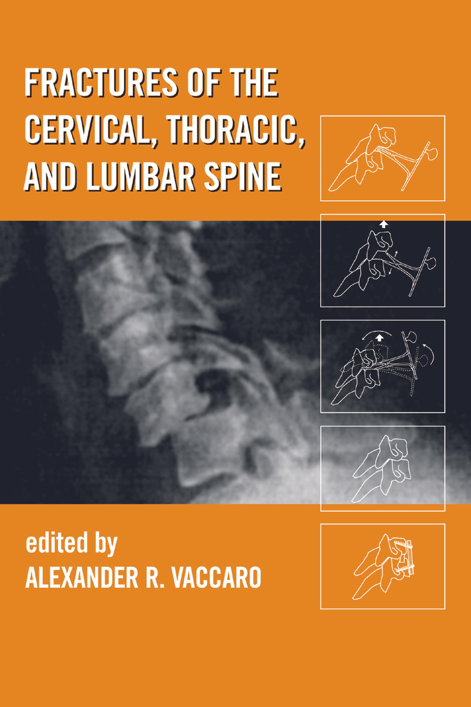 Fractures of the Cervical, Thoracic, and Lumbar Spine