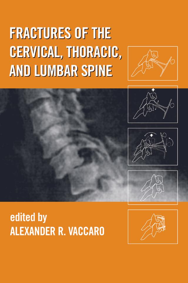 Fractures of the Cervical, Thoracic, and Lumbar Spine by Alexander R. Vaccaro