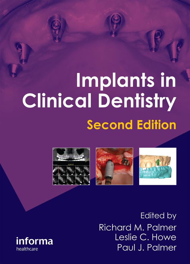 Implants in Clinical Dentistry by Leslie C. Howe, Paul J. Palmer, Richard M. Palmer