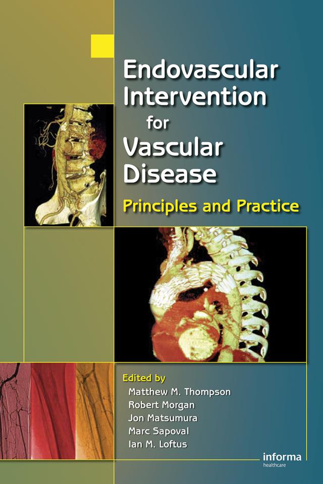 Endovascular Intervention for Vascular Disease by Ian M. Loftus, Jon S. Matsumura, Marc Sapoval, Matt M. Thompson, Robert A. Morgan