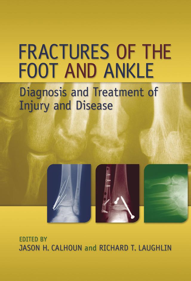 Fractures of the Foot and Ankle by Jason H. Calhoun, Richard T. Laughlin