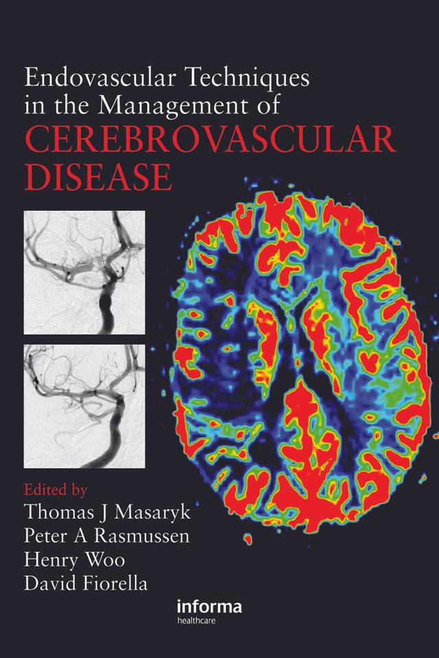Endovascular Techniques in the Management of Cerebrovascular Disease by David Fiorella, Henry Woo, Peter Rasmussen, Thomas J. Masaryk