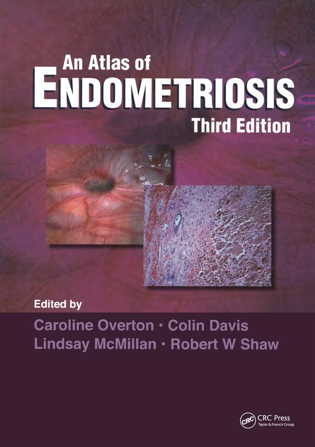 Atlas of Endometriosis by Caroline Overton, Colin Davis, Lindsay McMillan, Robert W. Shaw