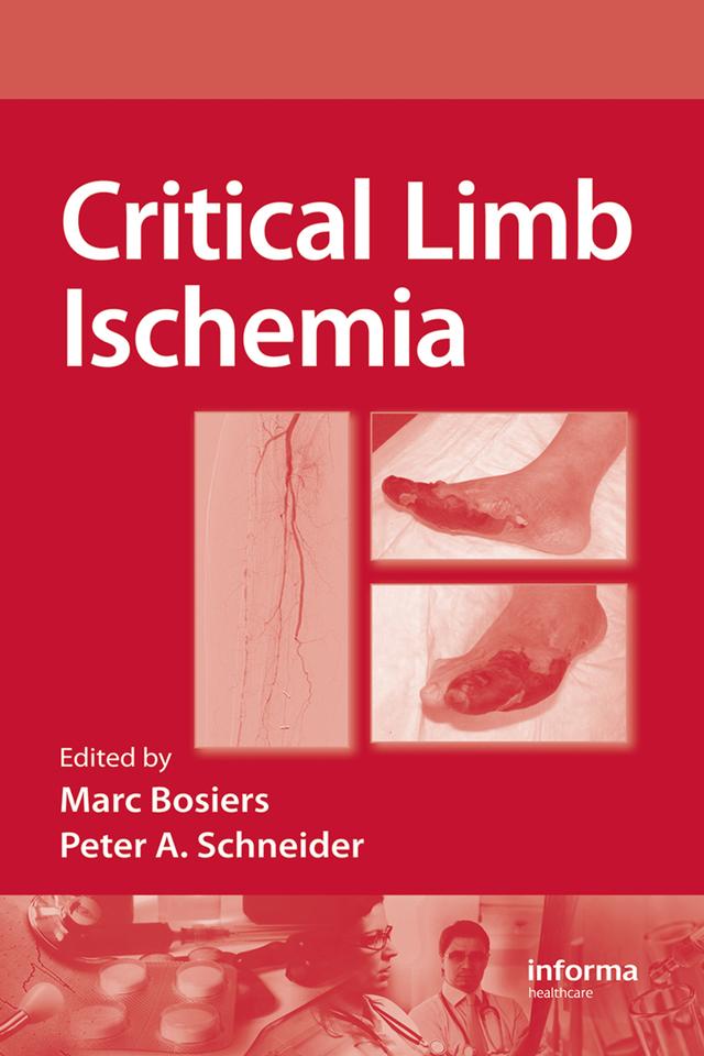 Critical Limb Ischemia by Marc Bosiers, Peter Schneider