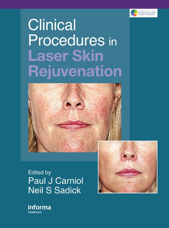 Clinical Procedures in Laser Skin Rejuvenation by Neil S. Sadick, Paul Carniol