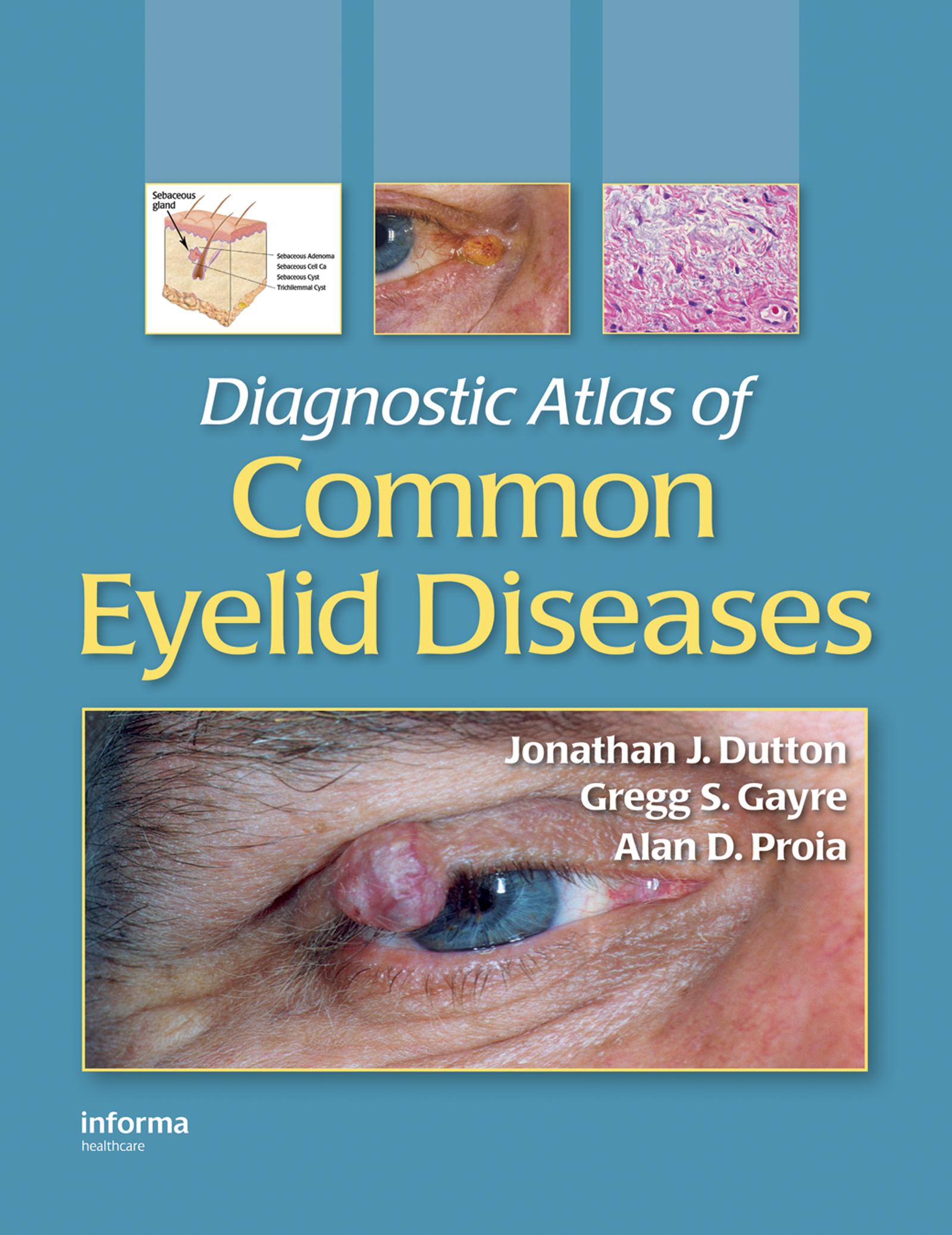 Diagnostic Atlas of Common Eyelid Diseases