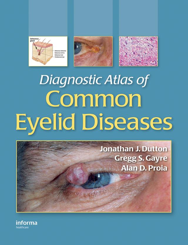 Diagnostic Atlas of Common Eyelid Diseases by Alan D. Proia, Gregg S. Gayre, Jonathan J. Dutton
