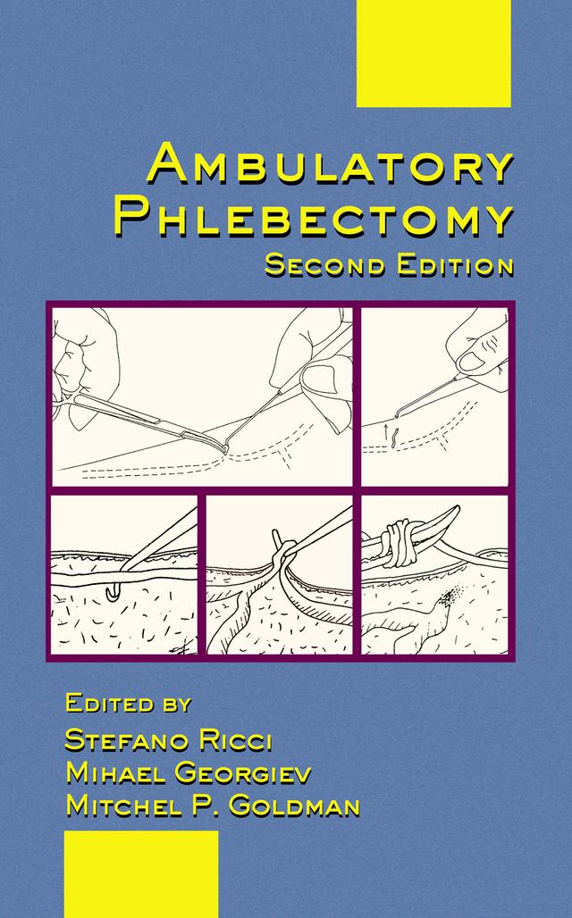 Ambulatory Phlebectomy by Mihael Georgiev, Mitchel P. Goldman, Stefano Ricci