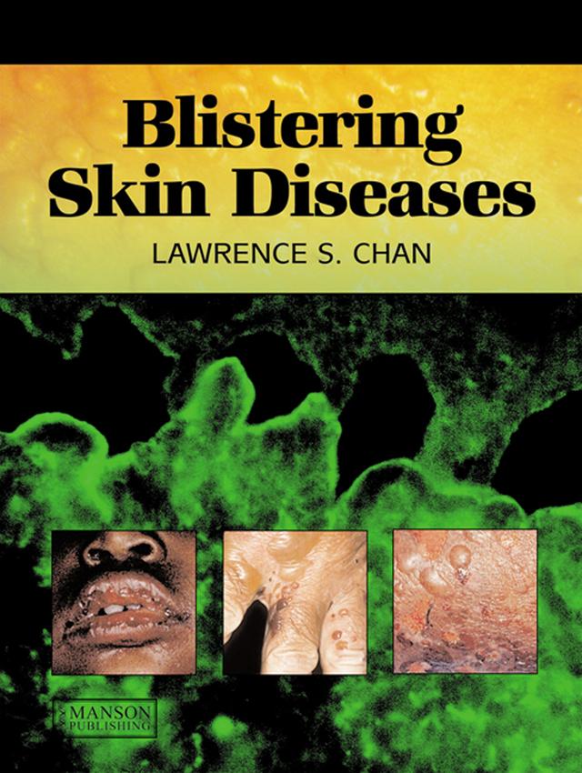 Blistering Skin Diseases by Lawrence Chan