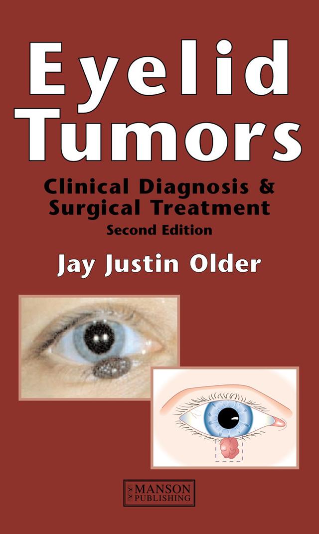 Eyelid Tumors by Jay Justin Older