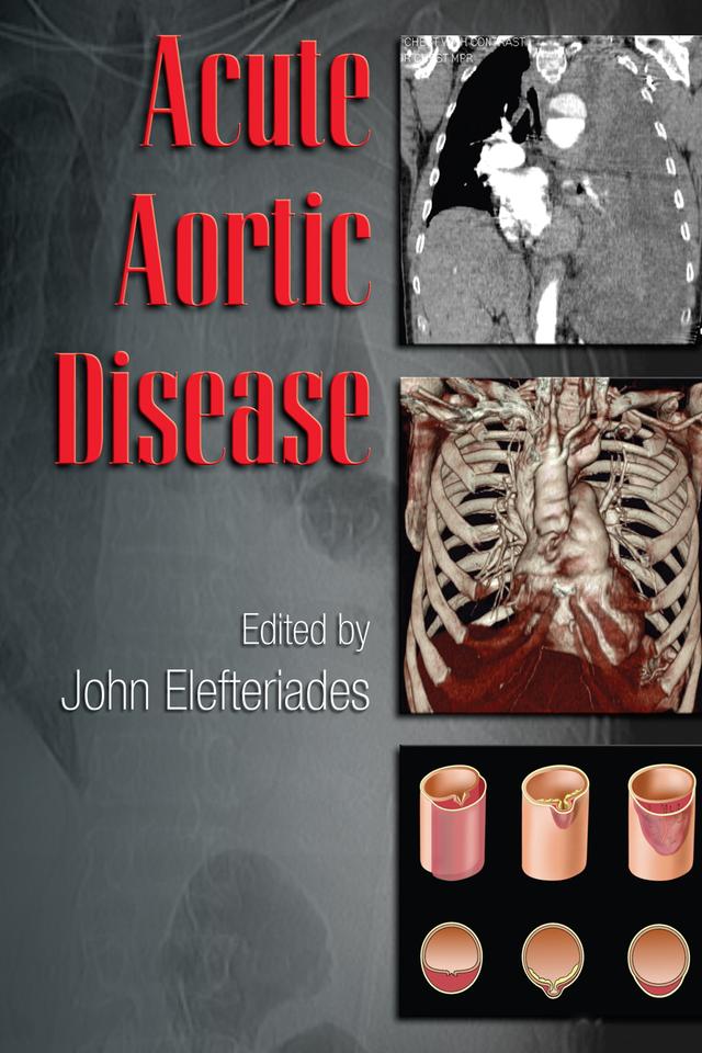 Acute Aortic Disease by John Elefteriades