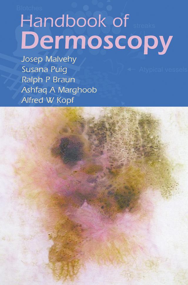 Handbook of Dermoscopy by Alfred W. Kopf, Ashfaq A. Marghoob, Josep Malvehy, Ralph P. Braun, Susana Puig