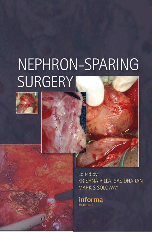 Nephron-Sparing Surgery by Krishna Sasidharan, Mark Soloway
