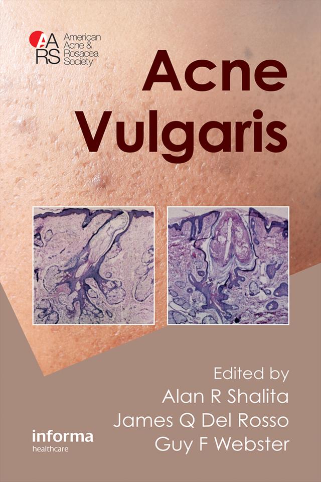 Acne Vulgaris by Alan R. Shalita, Guy Webster, James Q. Del Rosso