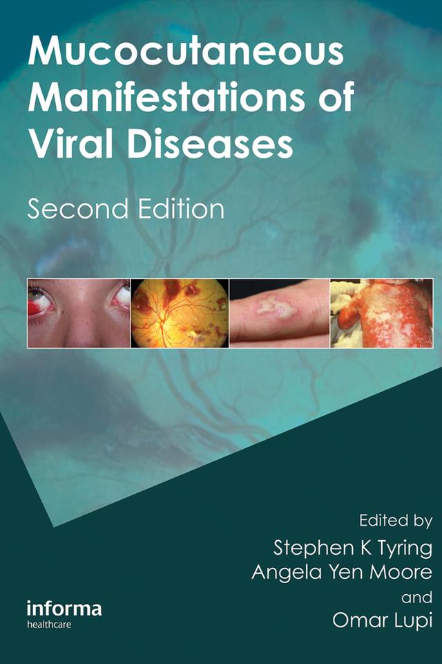 Mucocutaneous Manifestations of Viral Diseases by Angela Yen Moore, Omar Lupi, Stephen Tyring