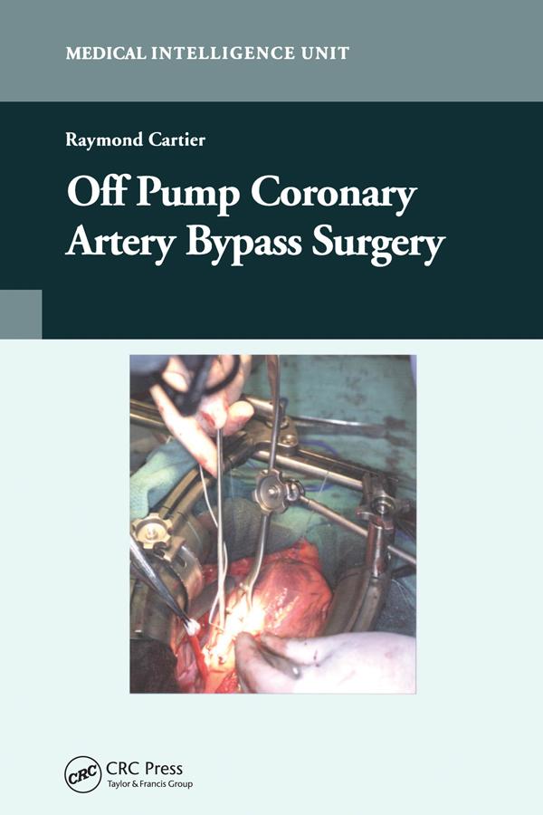 Off-Pump Coronary Artery Bypass Surgery by Raymond Cartier