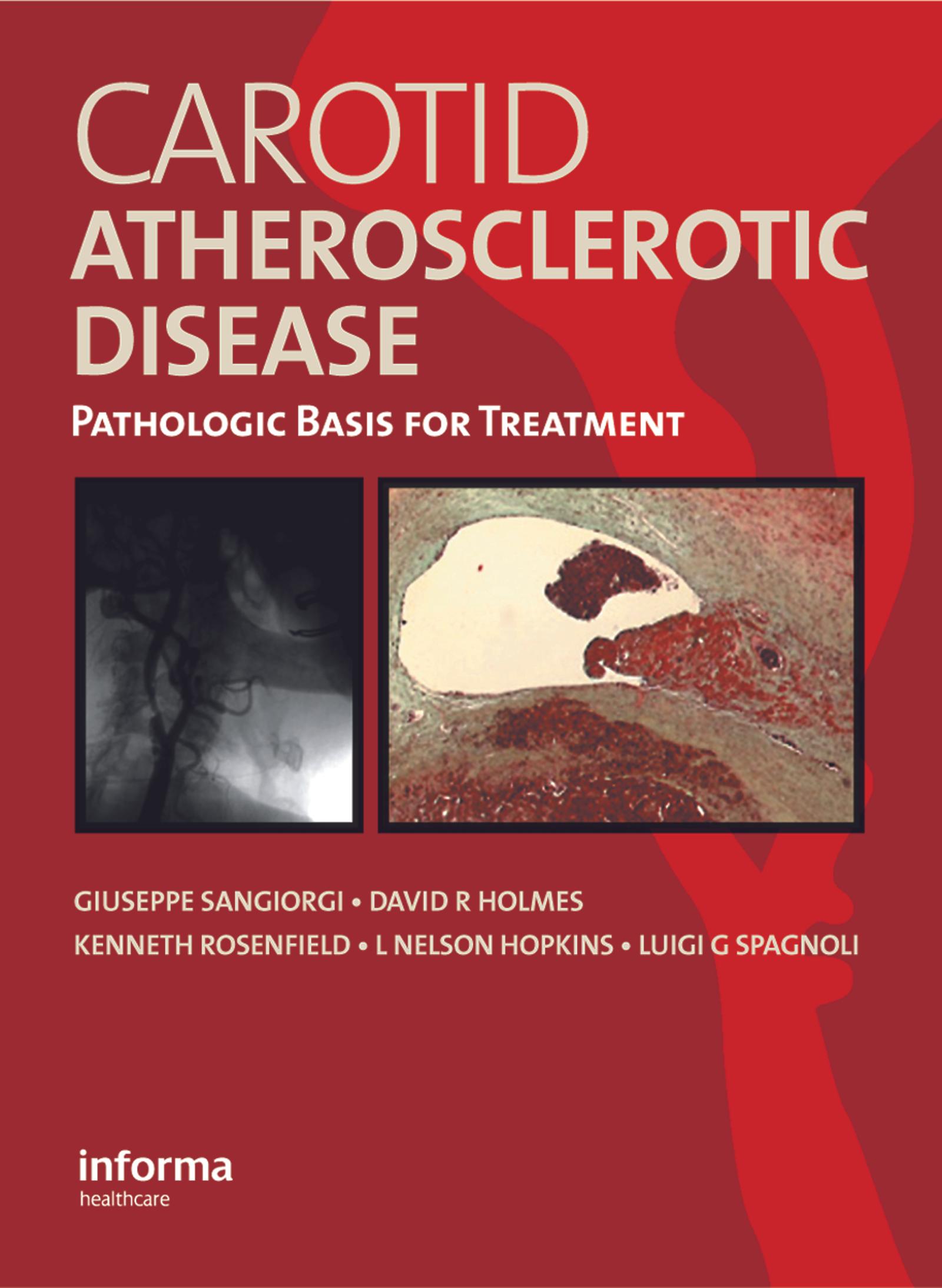Carotid Atherosclerotic Disease