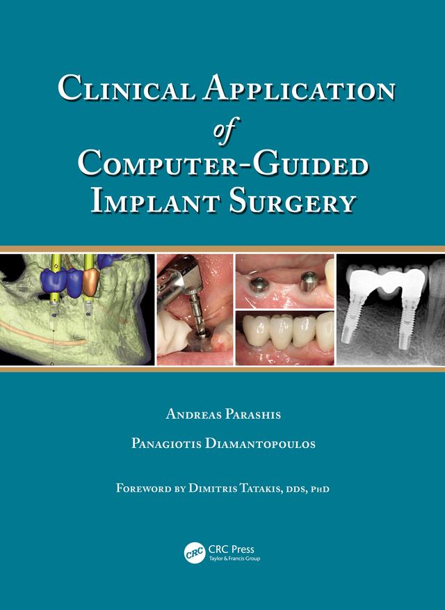 Clinical Application of Computer-Guided Implant Surgery by Andreas Parashis, Panagiotis Diamantopoulos