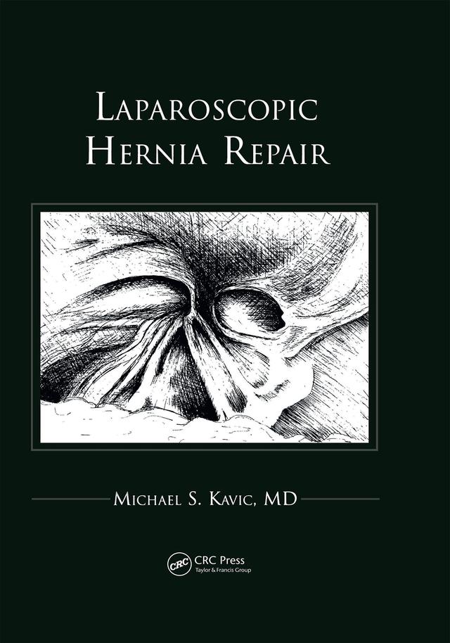 Laparoscopic Hernia Repair by Michael S Kavic
