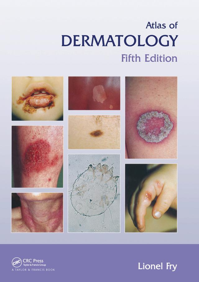 Atlas of Dermatology, Fifth Edition by Lionel Fry