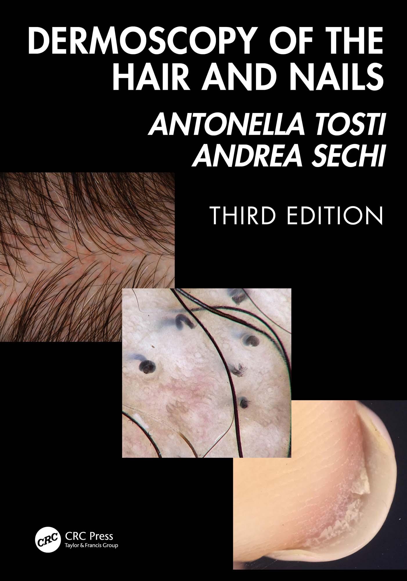 Dermoscopy of the Hair and Nails 3e