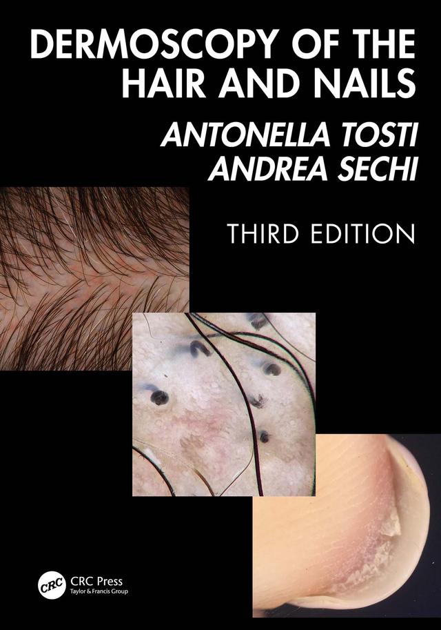 Dermoscopy of the Hair and Nails 3e by Andrea Sechi, Antonella Tosti