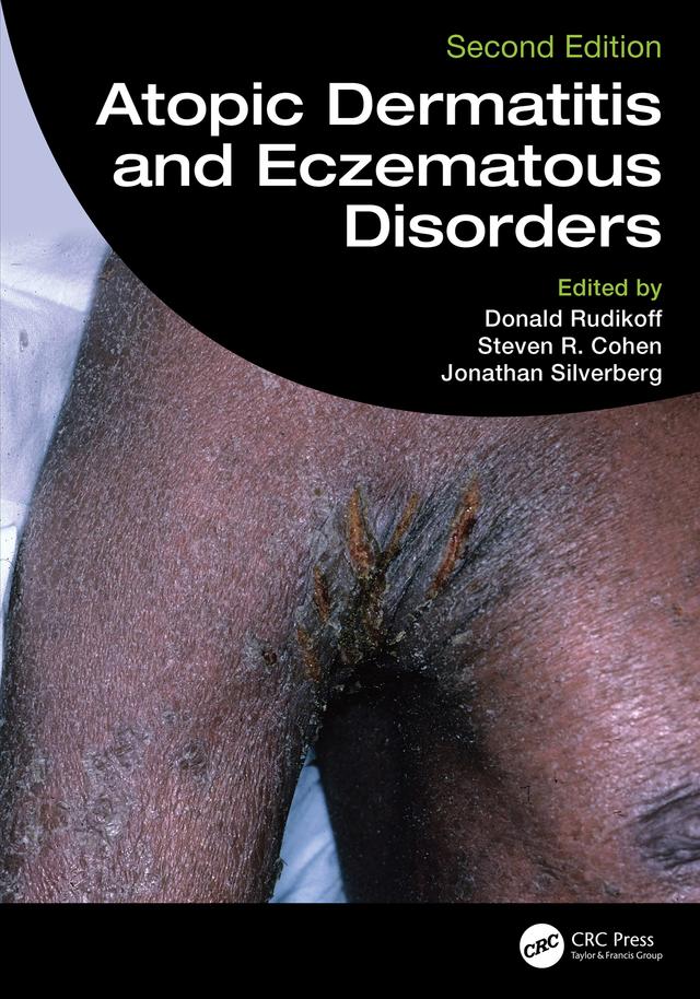 Atopic Dermatitis and Eczematous Disorders by Donald Rudikoff, Jonathan Silverberg, Steven R. Cohen