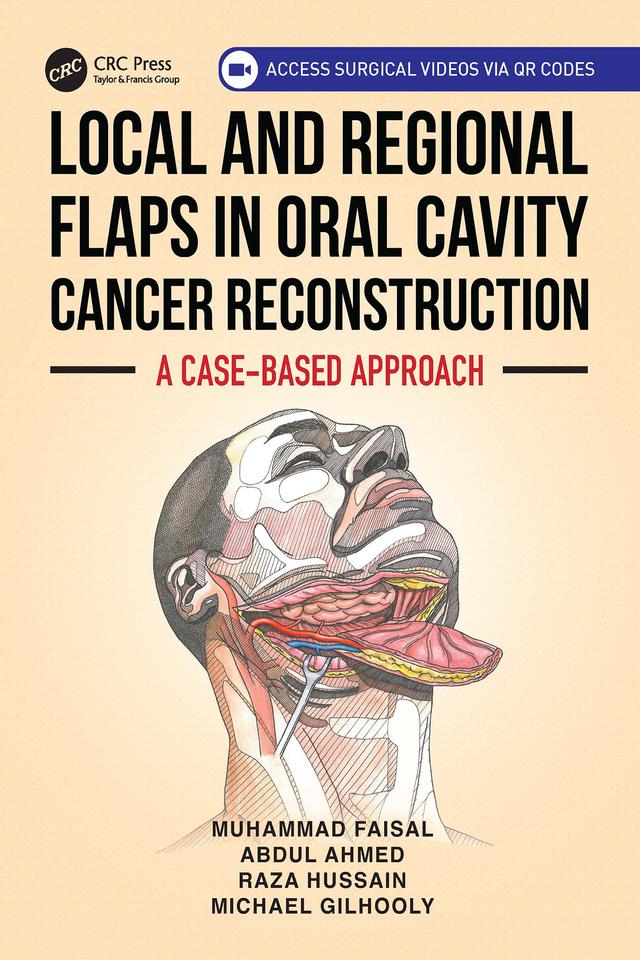 Local and Regional Flaps in Oral Cavity Cancer Reconstruction by Abdul Ahmed, Michael Gilhooly, Muhammad Faisal, Raza Hussain