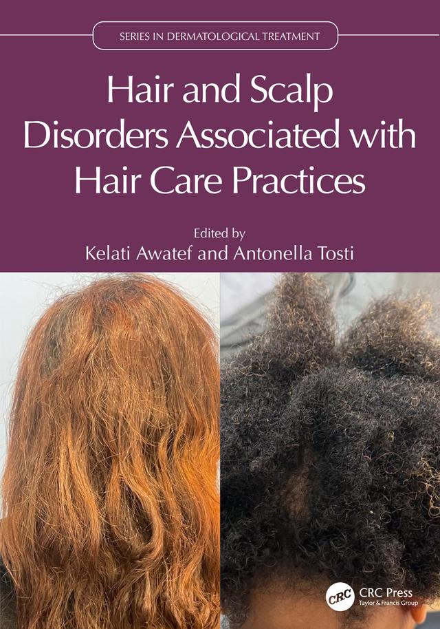 Hair and Scalp Disorders Associated with Hair Care Practices by Antonella Tosti, Kelati Awatef