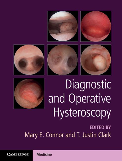 Diagnostic and Operative Hysteroscopy by Mary E. Connor, T. Justin Clark