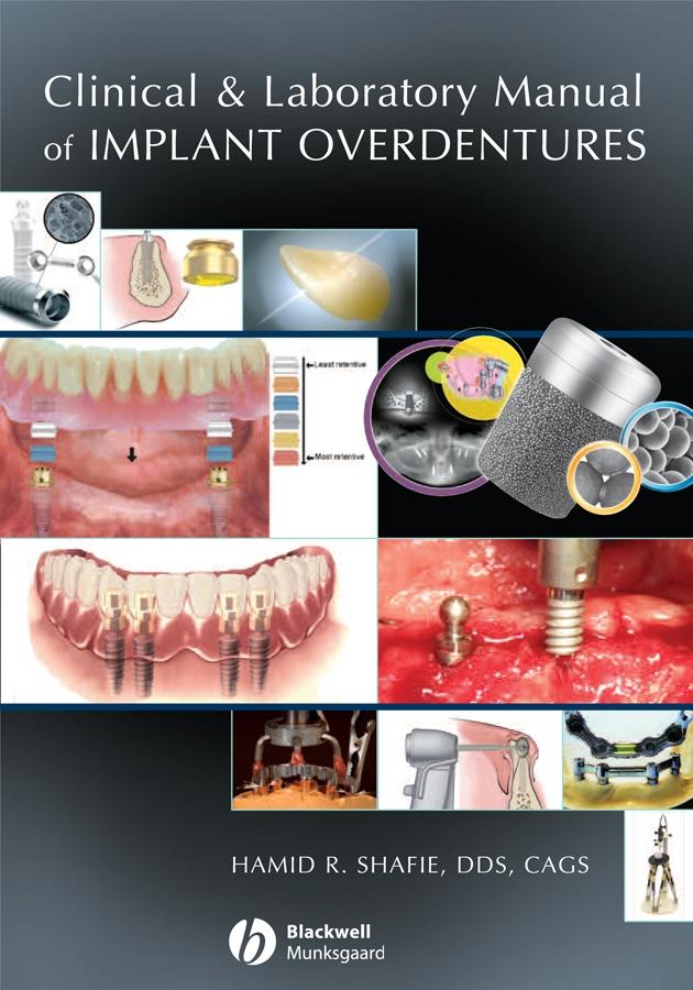 Clinical and Laboratory Manual of Implant Overdentures by Hamid R. Shafie