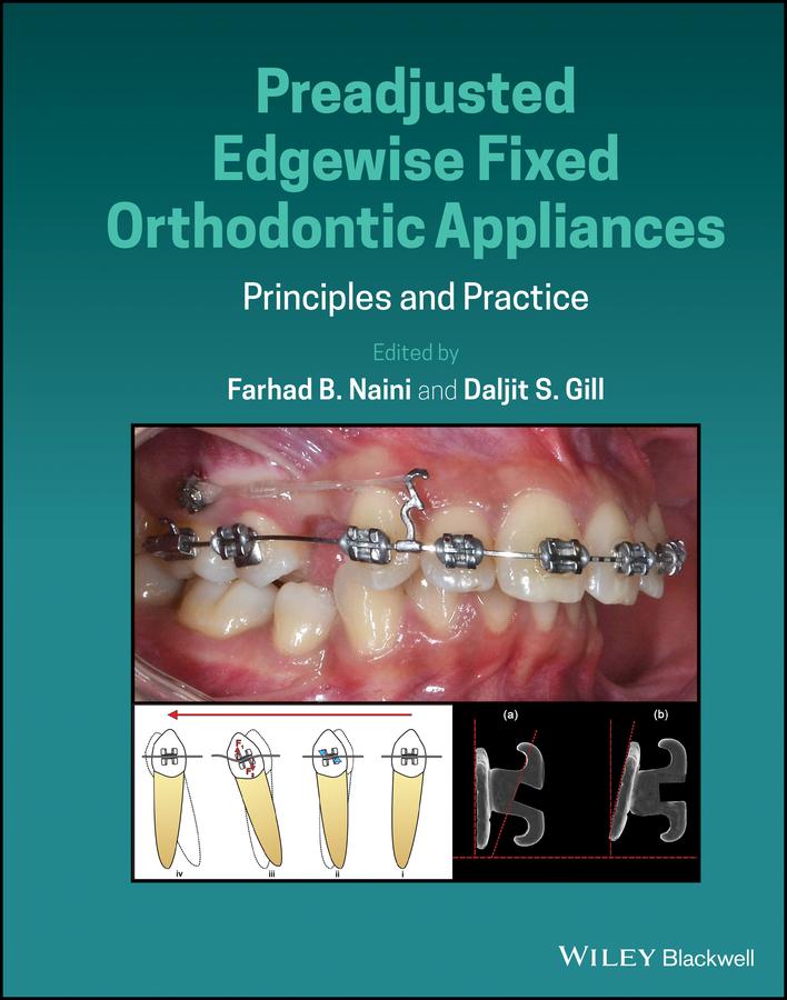 Preadjusted Edgewise Fixed Orthodontic Appliances