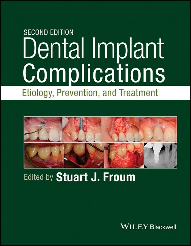 Dental Implant Complications by Stuart J. Froum