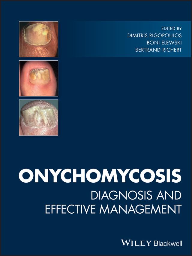 Onychomycosis by Bertrand Richert, Boni Elewski, Dimitris Rigopoulos