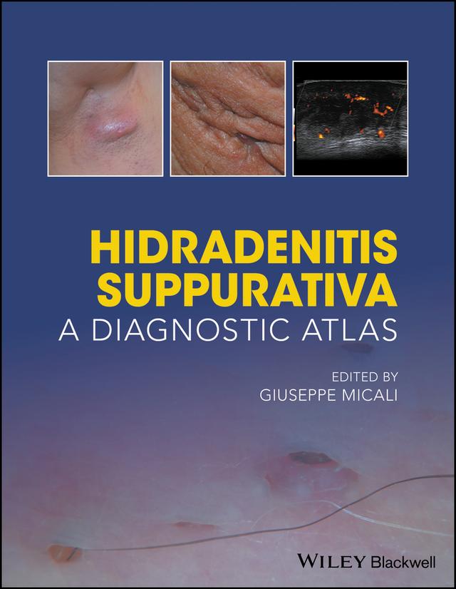 Hidradenitis Suppurativa by Giuseppe Micali