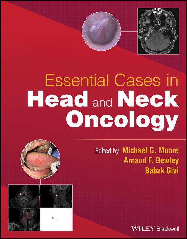 Essential Cases in Head and Neck Oncology by Arnaud F. Bewley, Babak Givi, Michael G. Moore