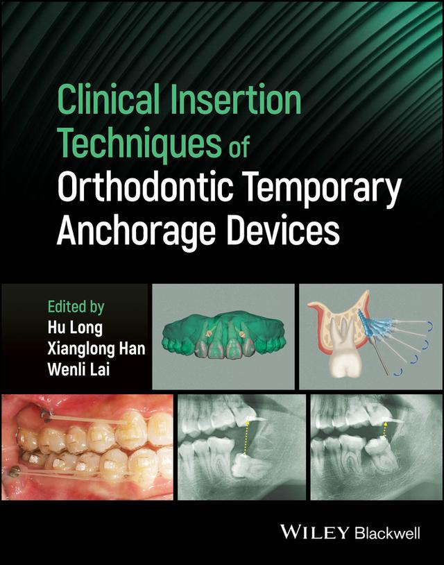 Clinical Insertion Techniques of Orthodontic Temporary Anchorage Devices by Hu Long, Wenli Lai, Xianglong Han