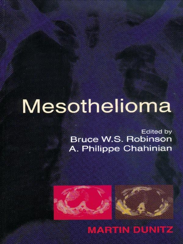 Mesothelioma by A Philippe Chahinian, Bruce W S Robinson