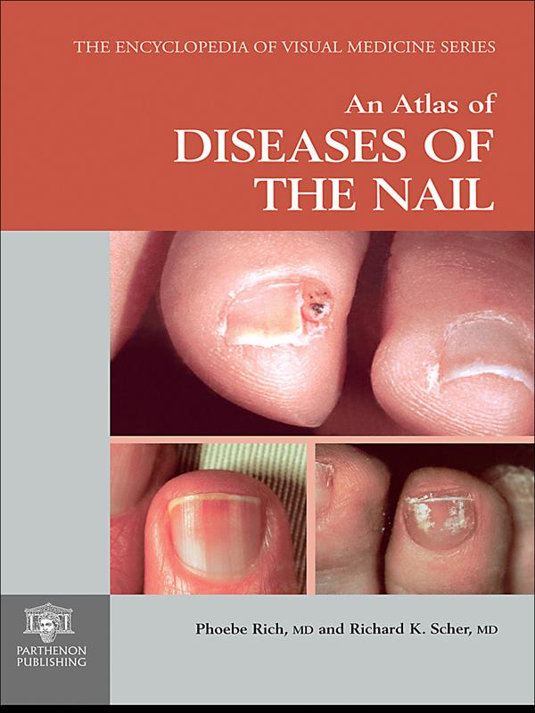 An Atlas of Diseases of the Nail by Phoebe Rich, Richard K. Scher