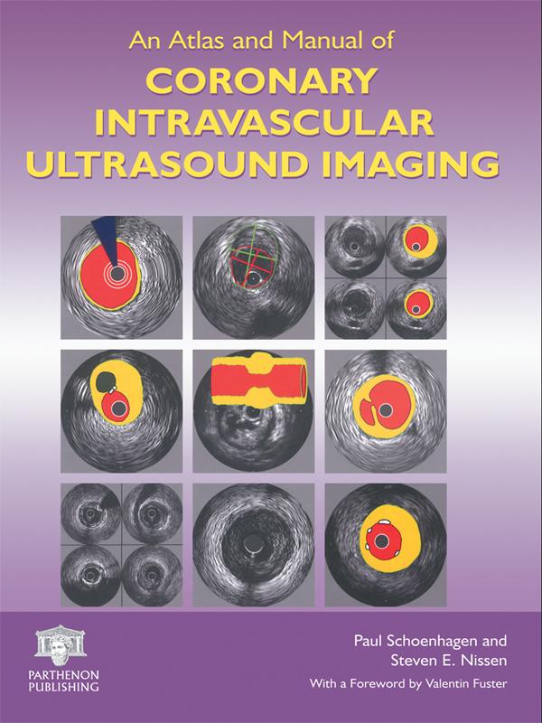 An Atlas and Manual of Coronary Intravascular Ultrasound Imaging by Paul Schoenhagen, Steven E. Nissen