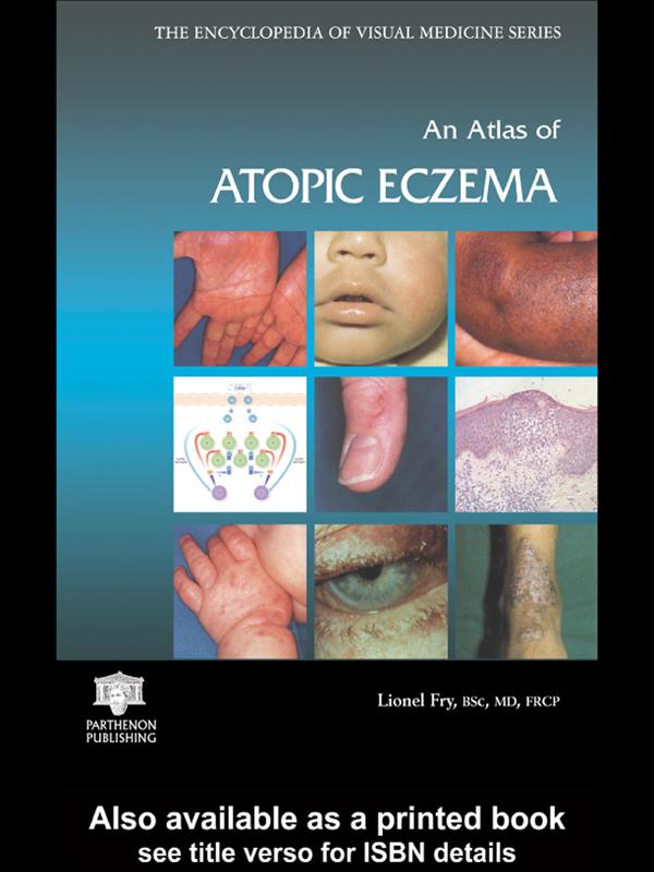An Atlas of Atopic Eczema by Lionel Fry