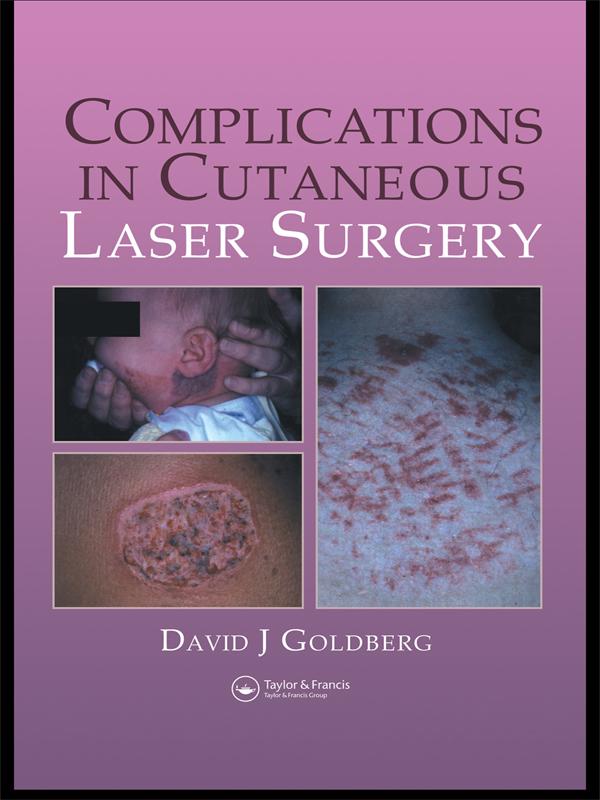Complications in Laser Cutaneous Surgery by David J. Goldberg