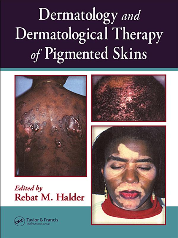 Dermatology and Dermatological Therapy of Pigmented Skins by Rebat Halder