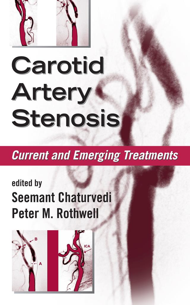 Carotid Artery Stenosis by Peter M. Rothwell, Seemant Chaturvedi